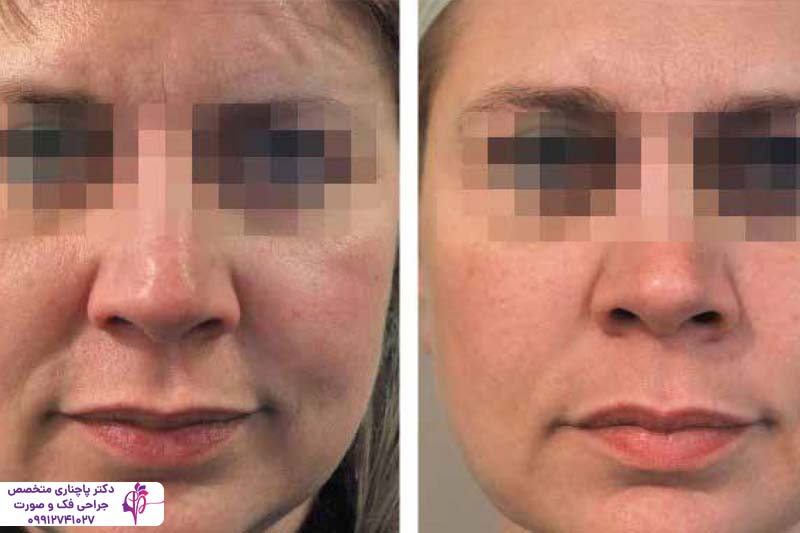 مراقبت‌های بعد از تزریق پروفایلو