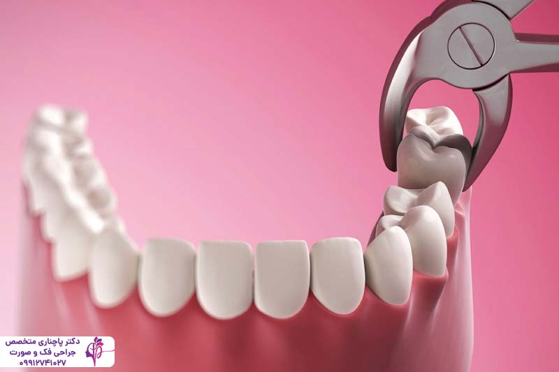 کشیدن دندان عقل