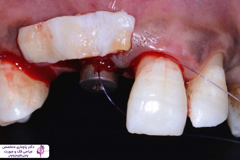 جراحی لثه برای ایمپلنت