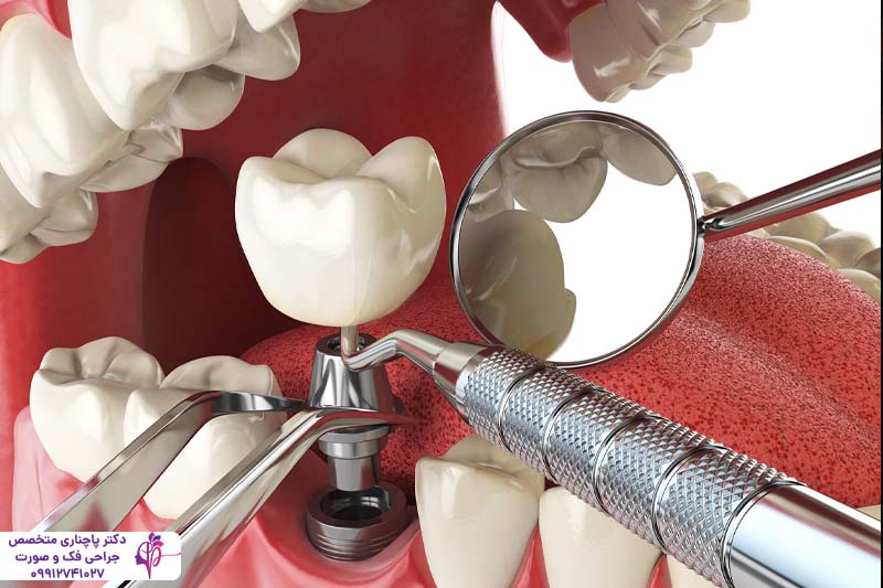 ایمپلنت آمریکایی زیمر Zimmer