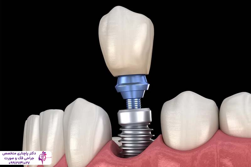 ایمپلنت و روکش دندان لترال