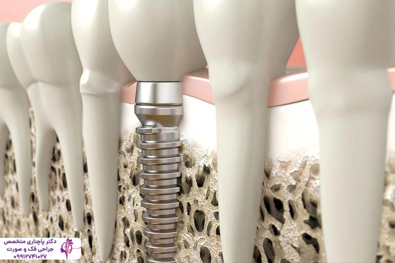 جراحی لثه برای ایمپلنت