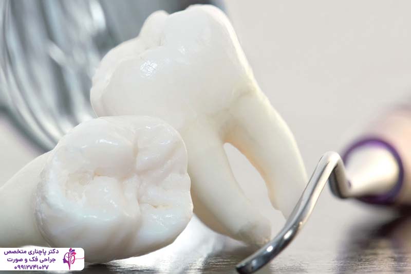 مزایا و معایب کشیدن دندان عقل