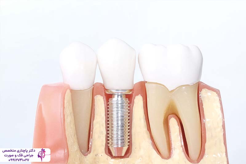 ایمپلنت دندان بیماران تیروئیدی