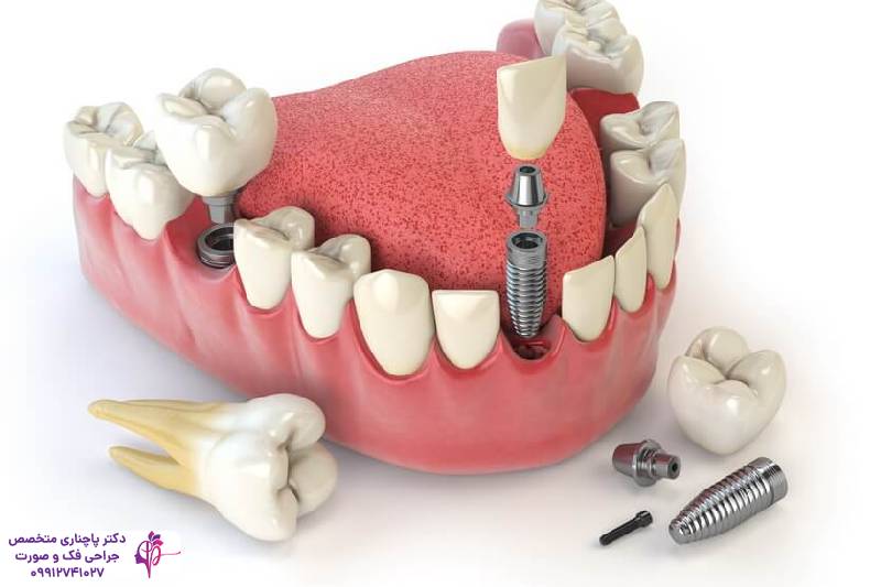 ایمپلنت دندان قدامی و خلفی