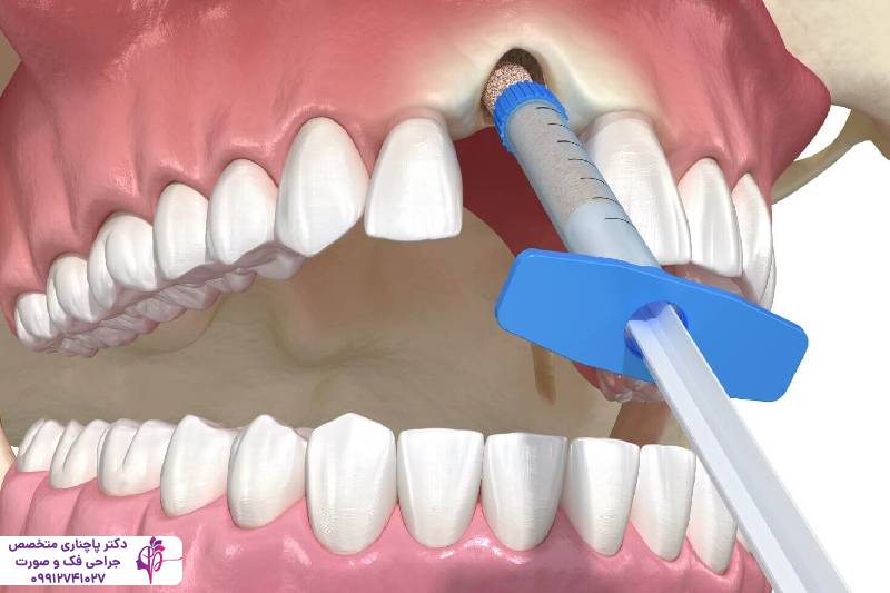 پیوند استخوان فک