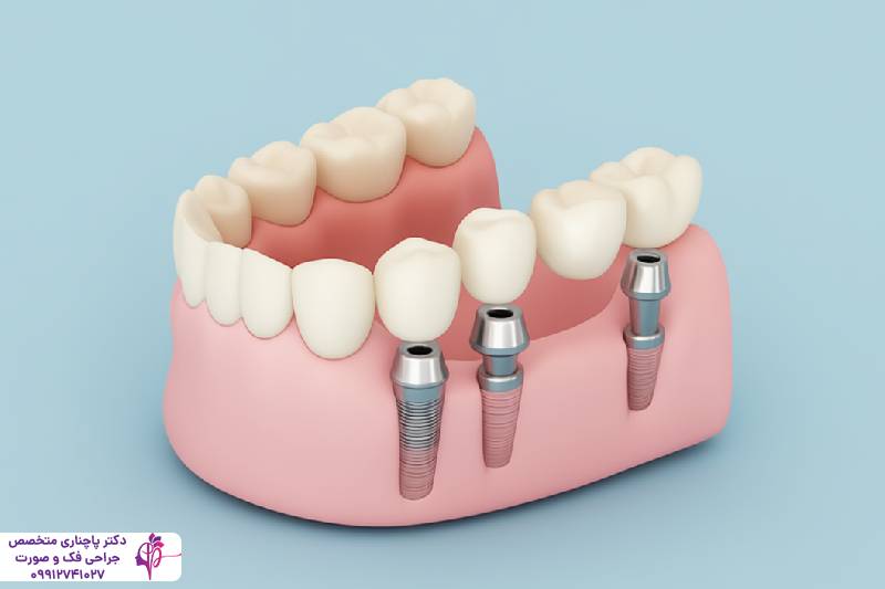 ایمپلنت دندان قدامی و خلفی