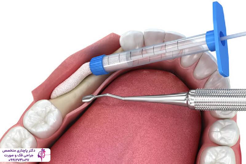 پیوند استخوان فک