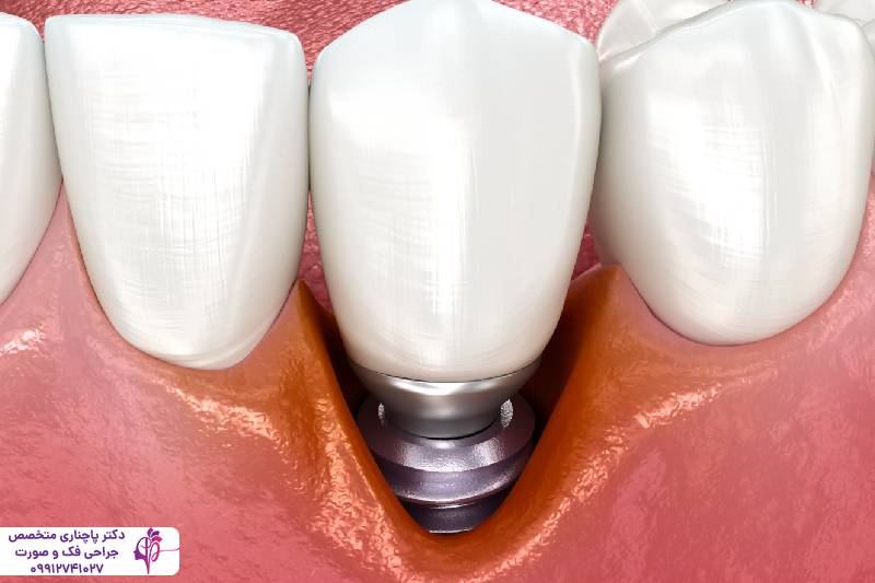 ایمپلنت دندان قدامی و خلفی