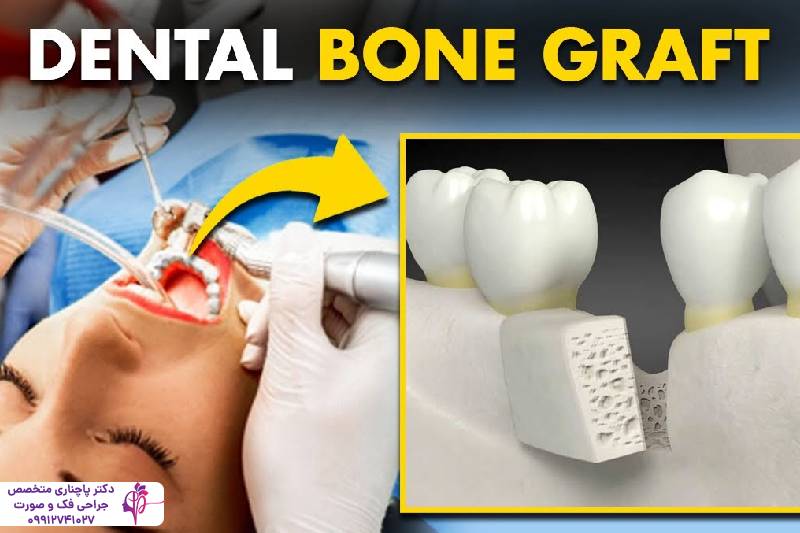 پیوند استخوان فک