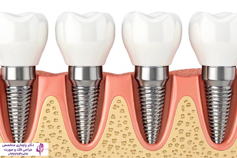 ایمپلنت دندان قدامی و خلفی