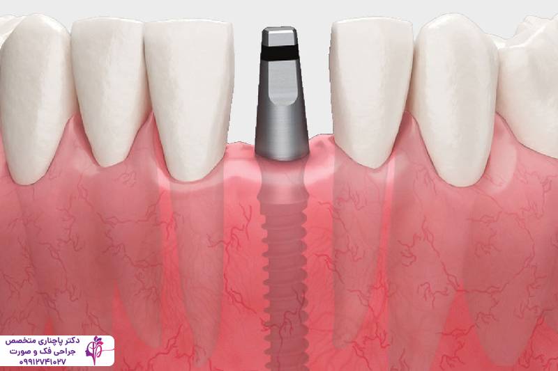 ایمپلنت دندان قدامی و خلفی
