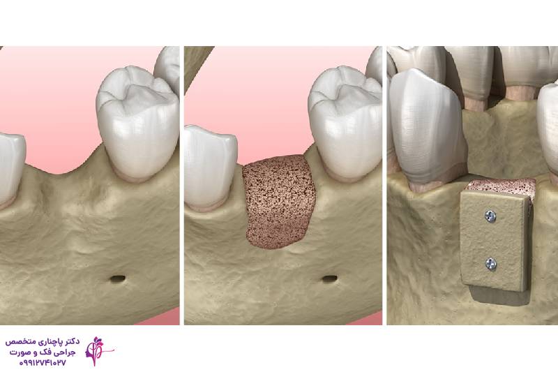 پیوند استخوان فک