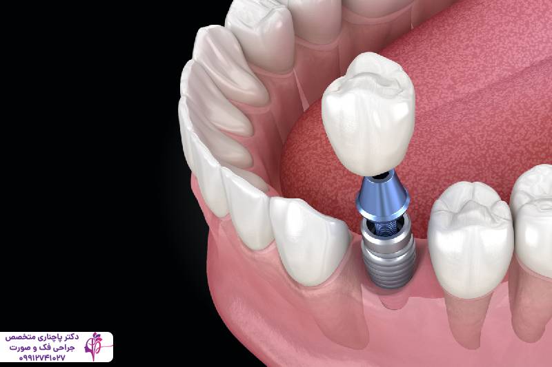 ایمپلنت دندان قدامی و خلفی