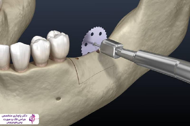 پیوند استخوان فک