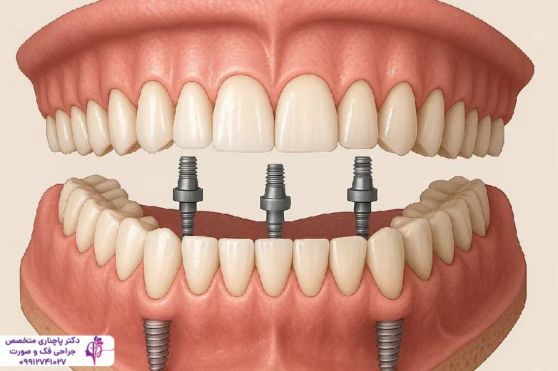 ایمپلنت دندان قدامی و خلفی