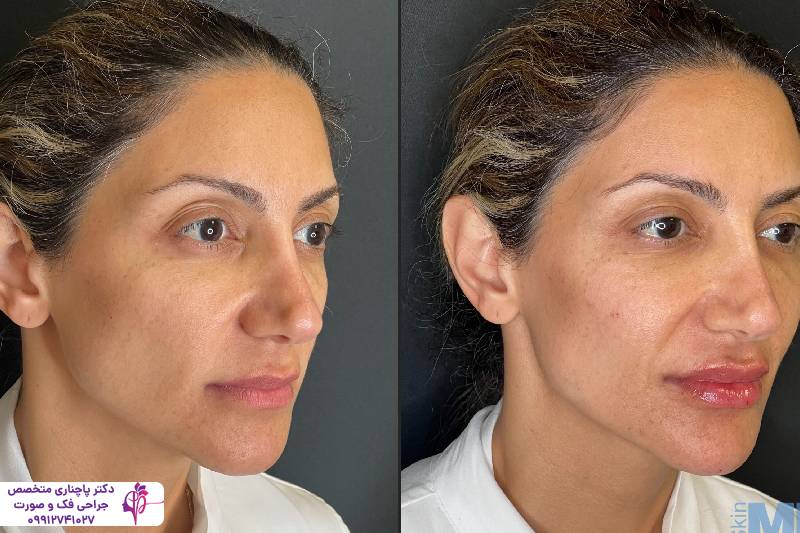 تزریق پروفایلو یا فیلر