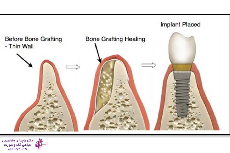پیوند استخوان فک
