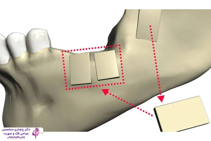 پیوند استخوان فک