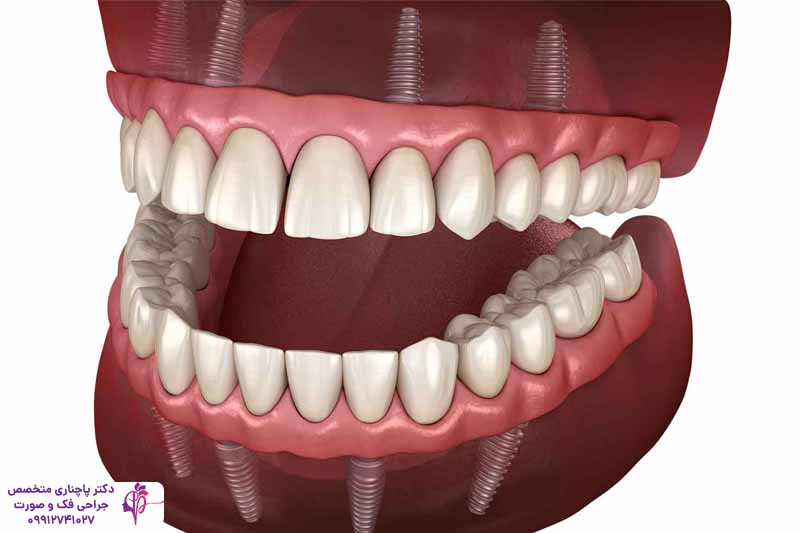 اوردنچر بر پایه ایمپلنت دندان