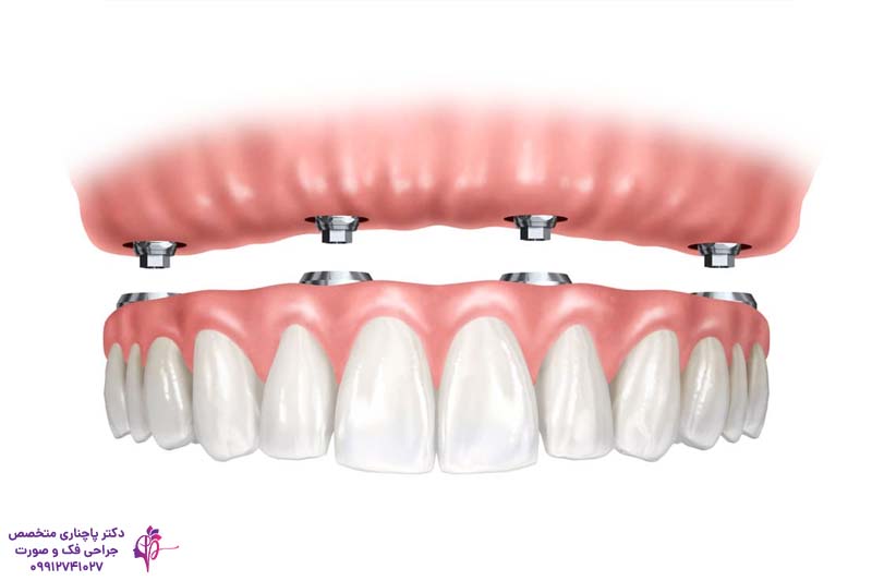 اوردنچر بر پایه ایمپلنت دندان