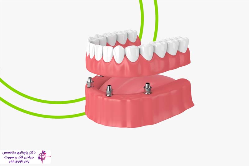 انواع اوردنچر دندان