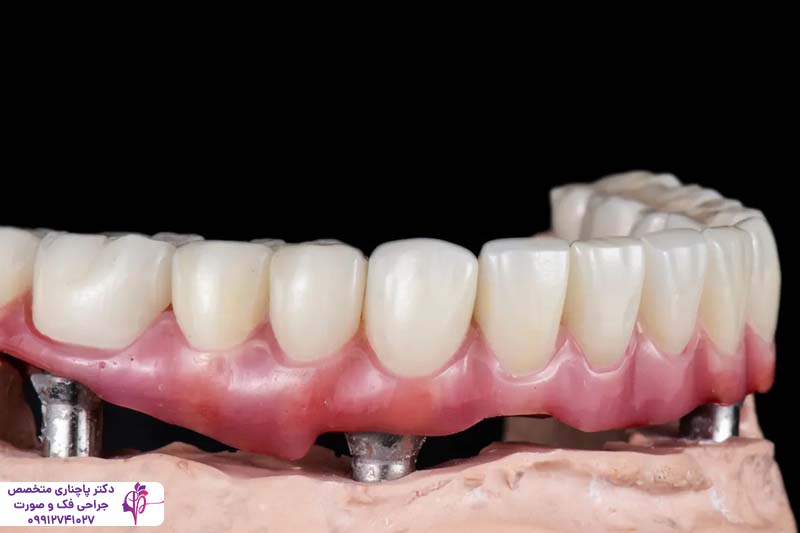 اوردنچر بر پایه ایمپلنت دندان