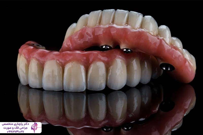 اوردنچر دندان