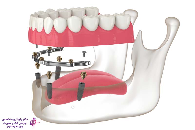اوردنچر بر پایه ایمپلنت دندان