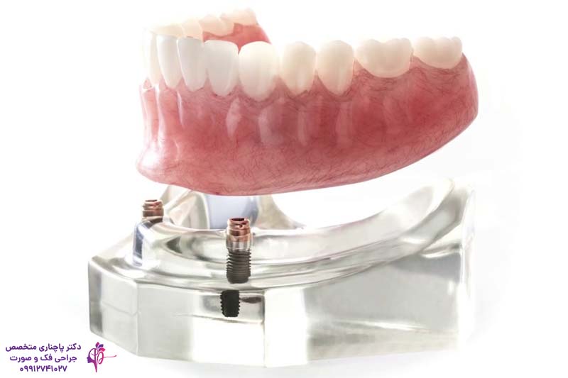 اوردنچر بر پایه ایمپلنت دندان