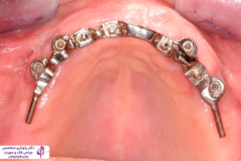 اوردنچر بر پایه ایمپلنت دندان