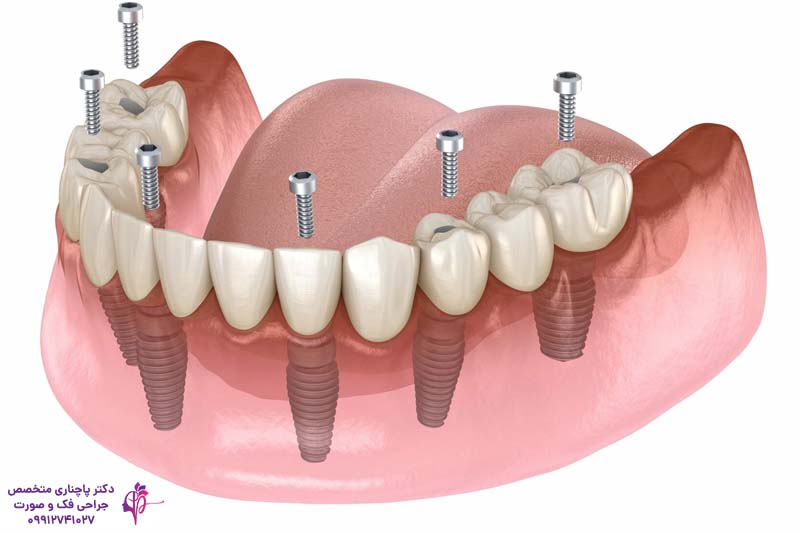 اوردنچر بر پایه ایمپلنت دندان