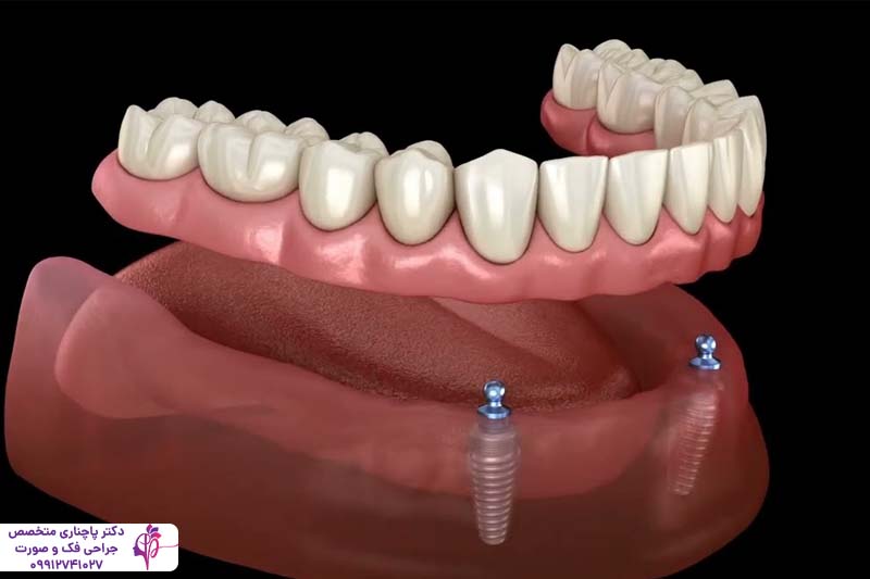 اوردنچر دندان