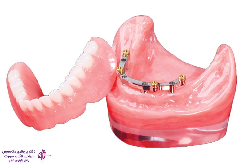 انواع اوردنچر دندان
