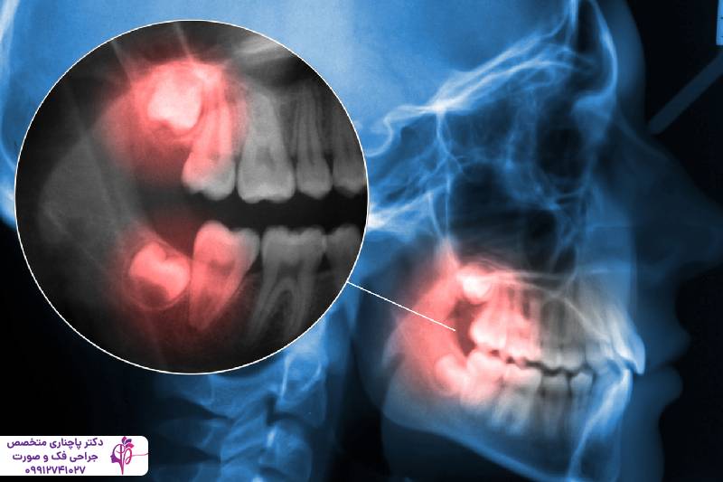 ارتباط درد گوش یا گلو با دندان عقل