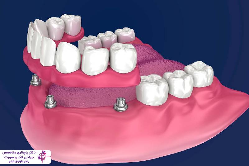 انواع اوردنچر دندان
