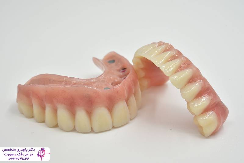 انواع اوردنچر دندان