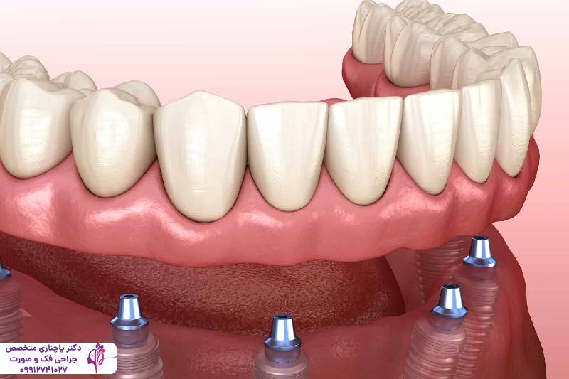 انواع اوردنچر دندان