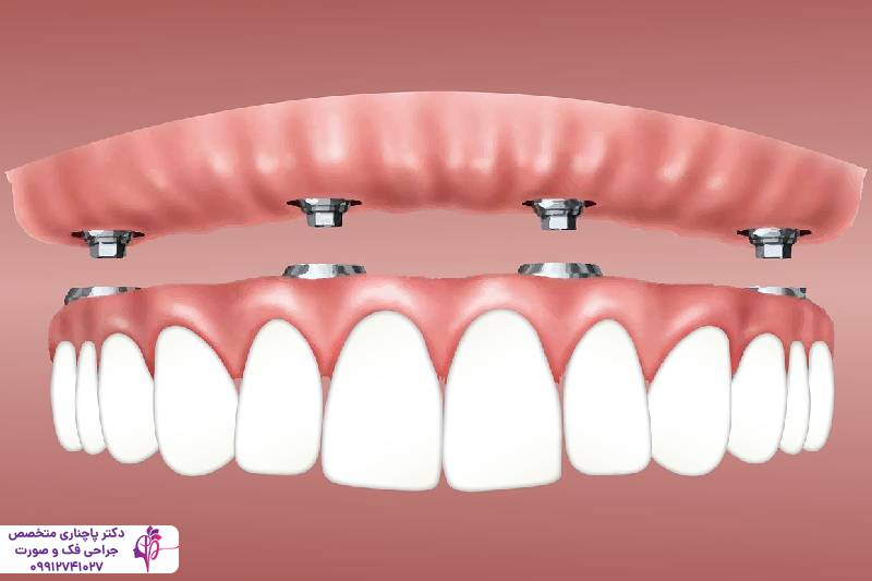 انواع اوردنچر دندان