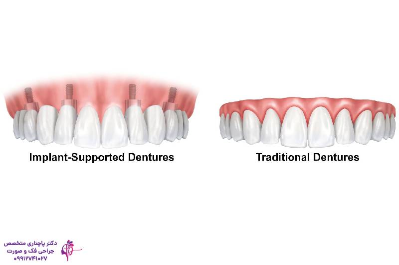 انواع اوردنچر دندان