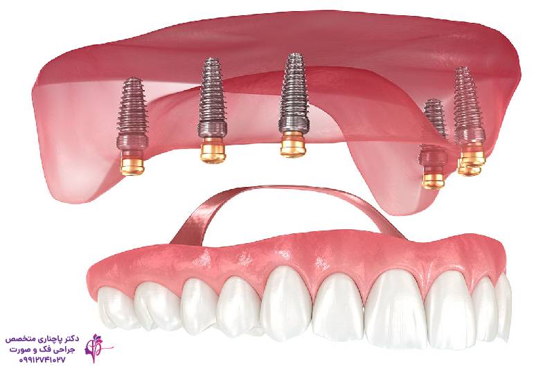 انواع اوردنچر دندان