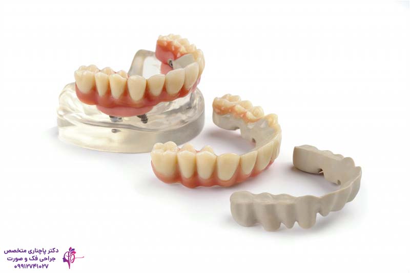 هزینه اوردنچر