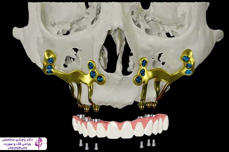 هزینه ایمپلنت ساب پریوستئال