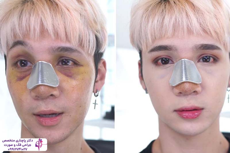 ورم و کبودی بعد از عمل بینی