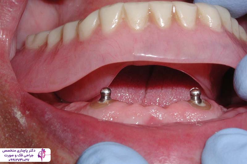 اوردنچر اقساطی در تهران