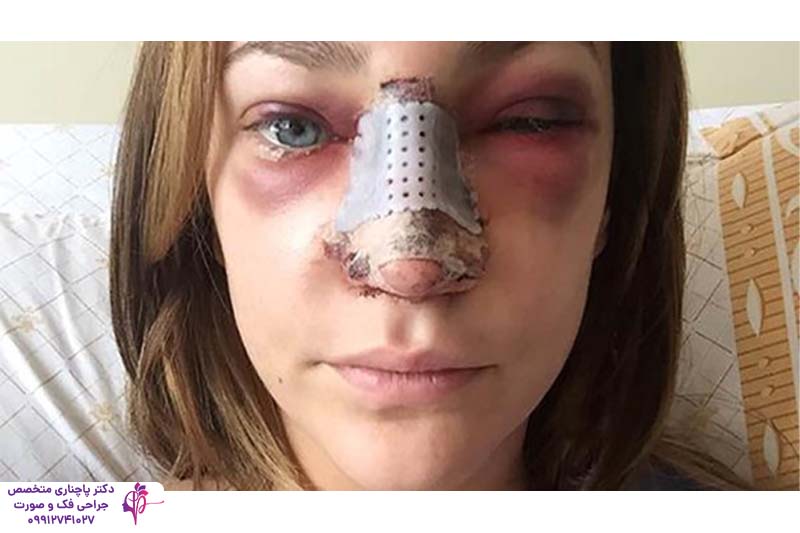 ورم و کبودی بعد از عمل بینی