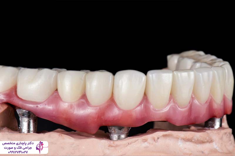 ایمپلنت هیبریدی