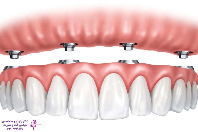ایمپلنت هیبریدی