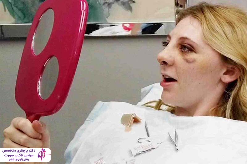 ورم و کبودی بعد از عمل بینی