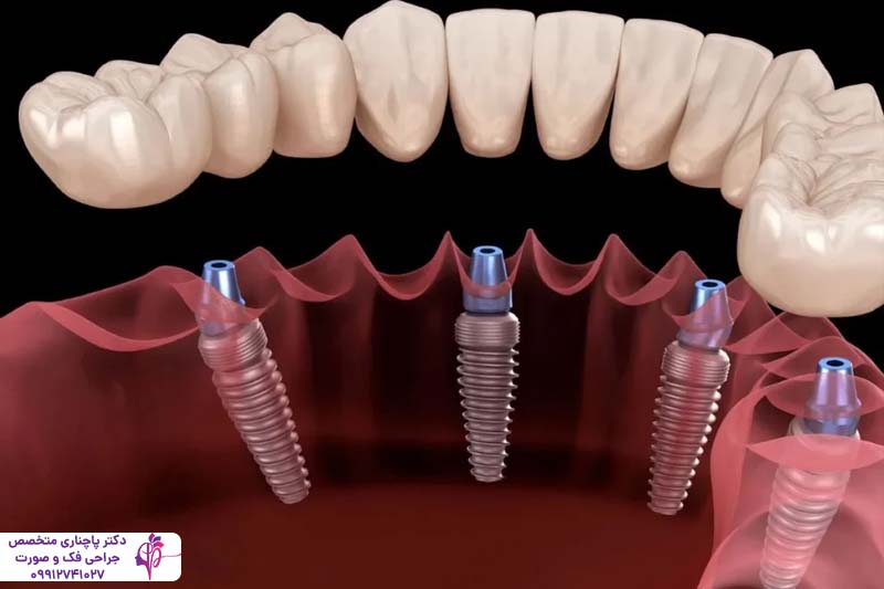 اوردنچر اقساطی در تهران